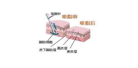 怎樣能快速瘦腿減肥