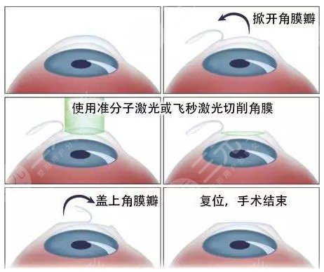 眼睛做激光手术有什么后遗症