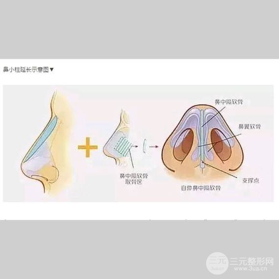 鼻中隔软骨隆鼻的优势和劣势