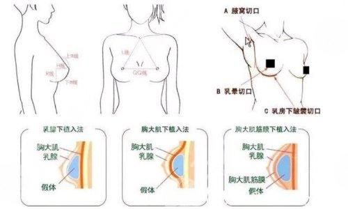 傲若拉假體怎么樣