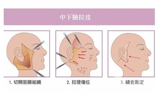 小切口除皺術(shù)比大拉皮好嗎