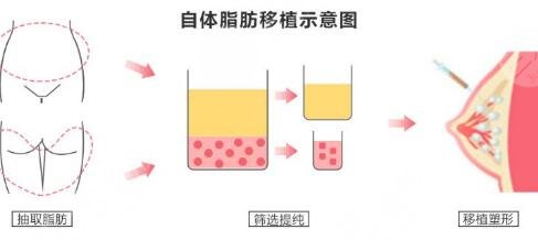 自體脂肪脂肪顆粒豐胸國內(nèi)外的價格是多少