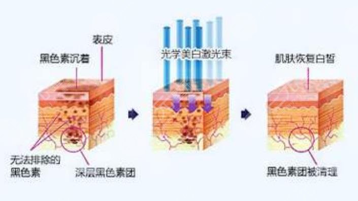 彩光嫩膚手術(shù)多少錢