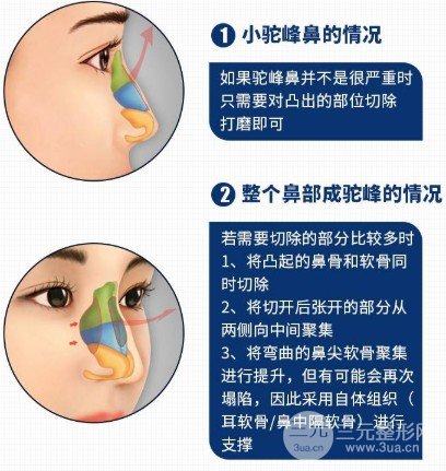 駝峰鼻整形前后對比