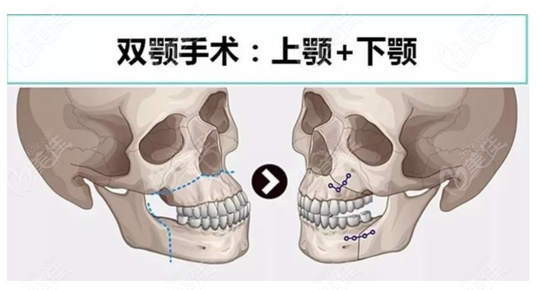 凸嘴手术和正颌手术的区别及关系看这2张图片就明白