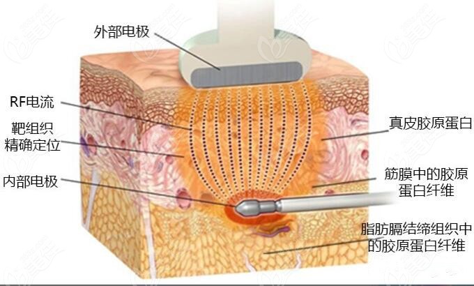 吸脂做水動(dòng)力好還是黃金微雕好