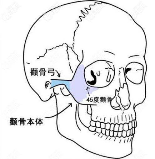 介紹顴骨內推手術是怎么做的