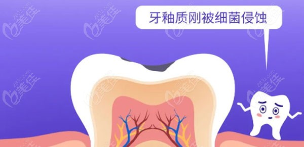 牙齒上的小黑洞會(huì)持續(xù)惡化