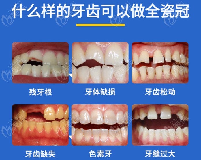 全瓷牙是一組好還是一個個做好