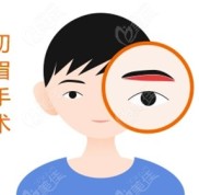 大慶切眉手術(shù)的價格來了