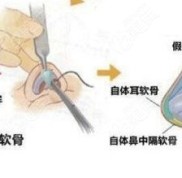 十堰隆鼻技術(shù)好的醫(yī)院公布了鼻綜合手術(shù)價(jià)格