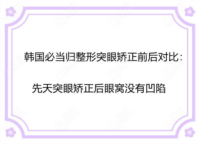 韓國必當(dāng)歸整形突眼矯正前后對比