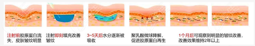 艾維嵐童顏針多久可以出成效