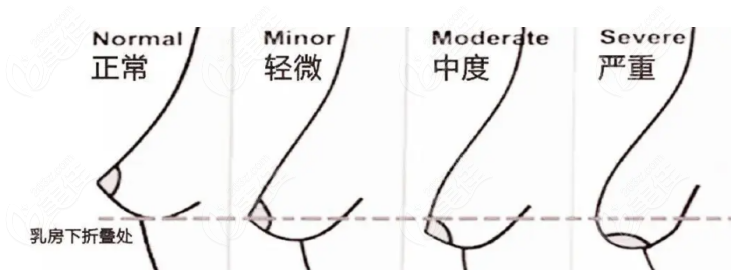 胸挺大的但下垂