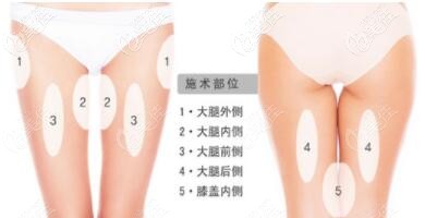 做大腿環(huán)吸一定要全麻嗎