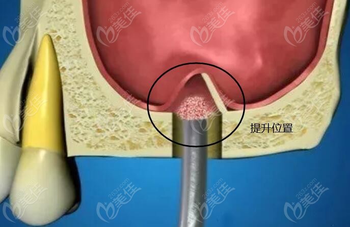 种植牙为什么要做上颌窦提升