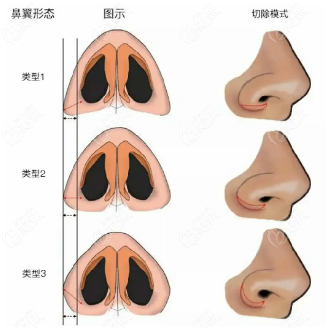 从鼻翼缩小手术内切和外切的区别来了解该怎么选择