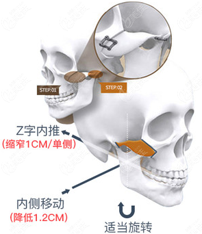 在杭州做顴骨內(nèi)推到底哪家醫(yī)院好啊