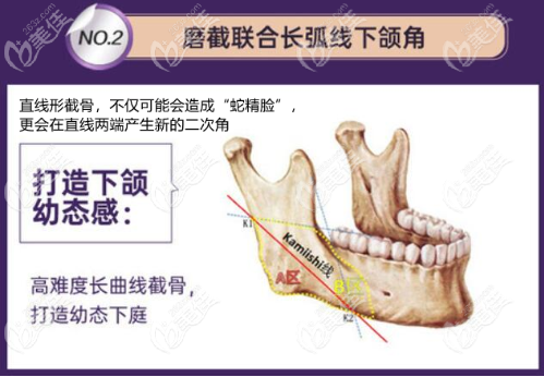 ?重庆做下颌角手术3万元起