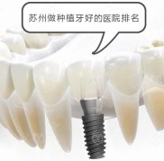 蘇州種植牙醫(yī)院排名榜匯集靠譜的醫(yī)院