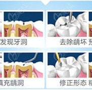 惠州補(bǔ)牙多少錢一顆