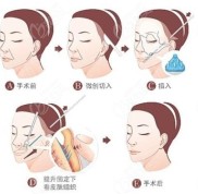 太原拉皮整形多少錢跟你做面部大拉皮還是微創(chuàng)小切口去抬頭紋有關(guān)