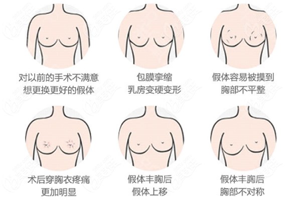 ?上海隆胸假体取出医院哪家便宜又好