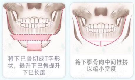 為什么下巴T型截骨手術(shù)不建議做