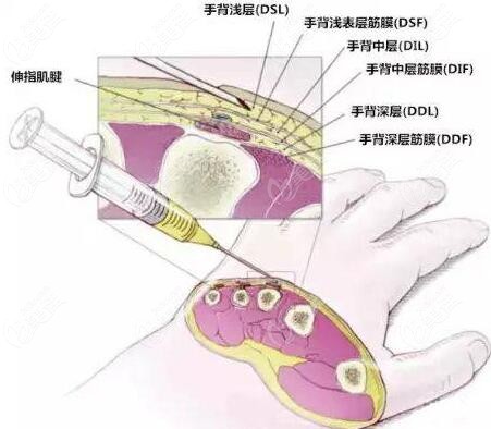 手背皺紋特別多該怎么消除