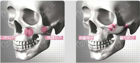 上海颧骨内推哪个医生好呢