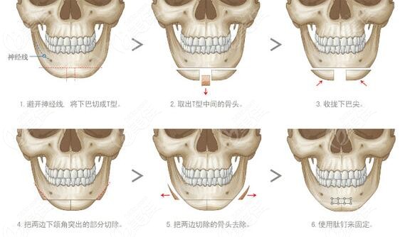 了解到頦部成形術(shù)是大手術(shù)后