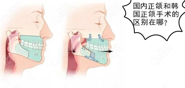 韩国正颌手术为什么不用术前正畸