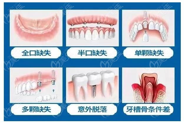 成都锦江区种植牙比较好的牙科医院是