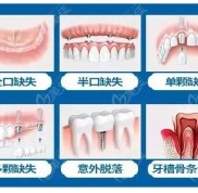 內(nèi)江種植牙價格表中包含內(nèi)江一顆和全口種植牙多少錢