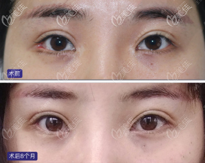三张外眼角修复手术前后对比图一眼就能看出开外眼角能开多大