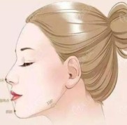 下頜線不清晰到沈陽杏林做下頜緣緊致提升效果好不好