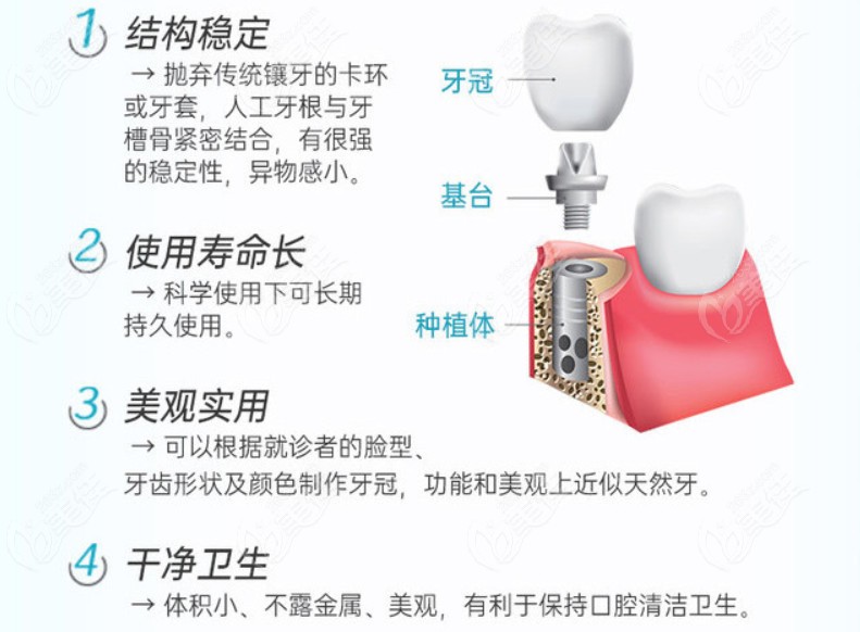 杭州平海路口腔医院种牙价格表为您诠释种牙得花多少钱
