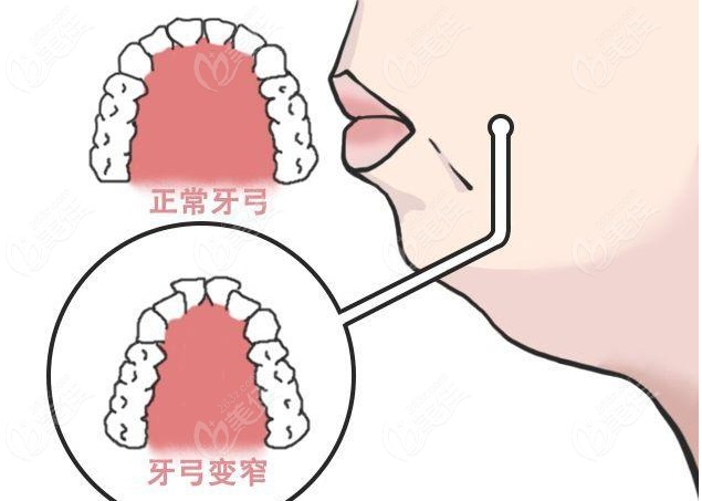 话说牙弓窄一定要扩弓么