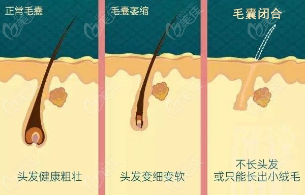 毛囊萎縮和毛囊閉合的區(qū)別或原因你知道嗎