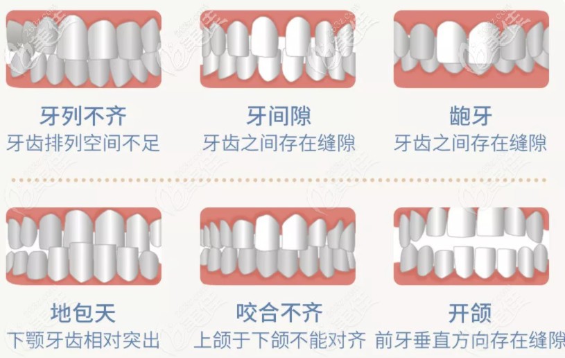 贵阳成人牙齿矫正价格表C位出道