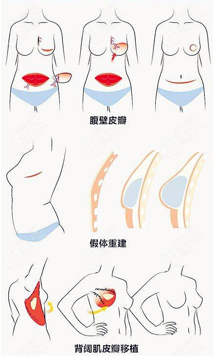 乳腺癌切除手術(shù)可以和乳房再造術(shù)可以同時一次完成嗎