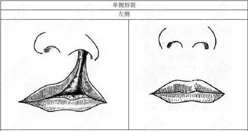 隱唇裂不修復(fù)鼻子會越來越塌嗎