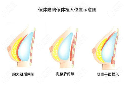 乳房懸吊提升手術(shù)風(fēng)險(xiǎn)大不大