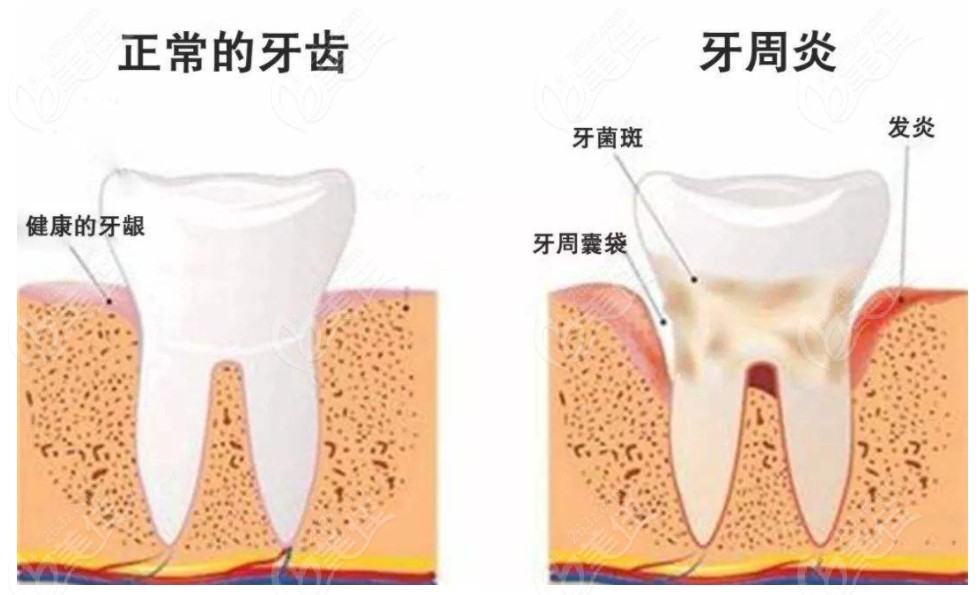 牙齦萎縮恢復(fù)手術(shù)價(jià)位了解下