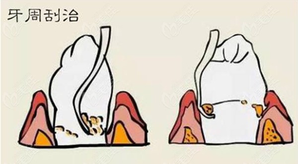 牙周炎刮治費(fèi)用是多少