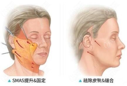 如果做耳前切口拉皮手術(shù)后疤痕明顯嗎