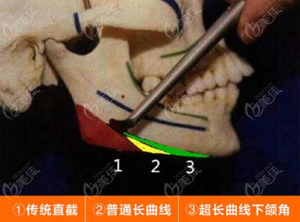 细数北京下颌角手术做得厉害的医生