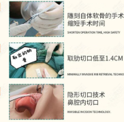 重慶軍美章小平隆鼻怎么樣
