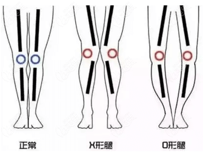 北京禾美嘉做X/O型腿矫正挺好的