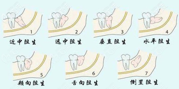 很多人找拔智齒的難度系數(shù)圖